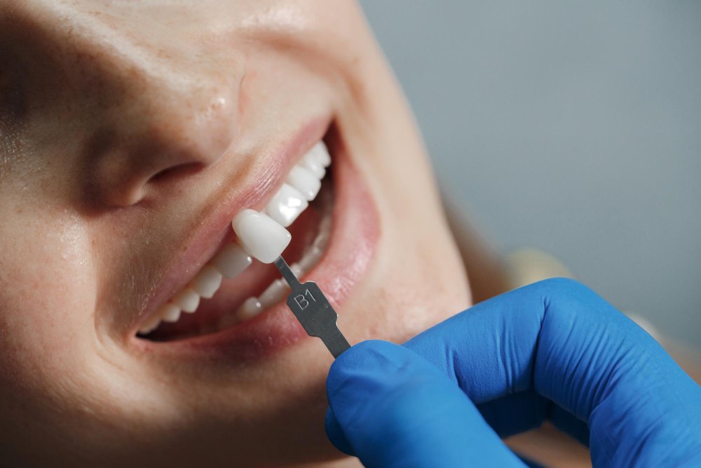 A dentist's hand wearing a blue glove is applying a shade guide to a patient's teeth during a dental examination.