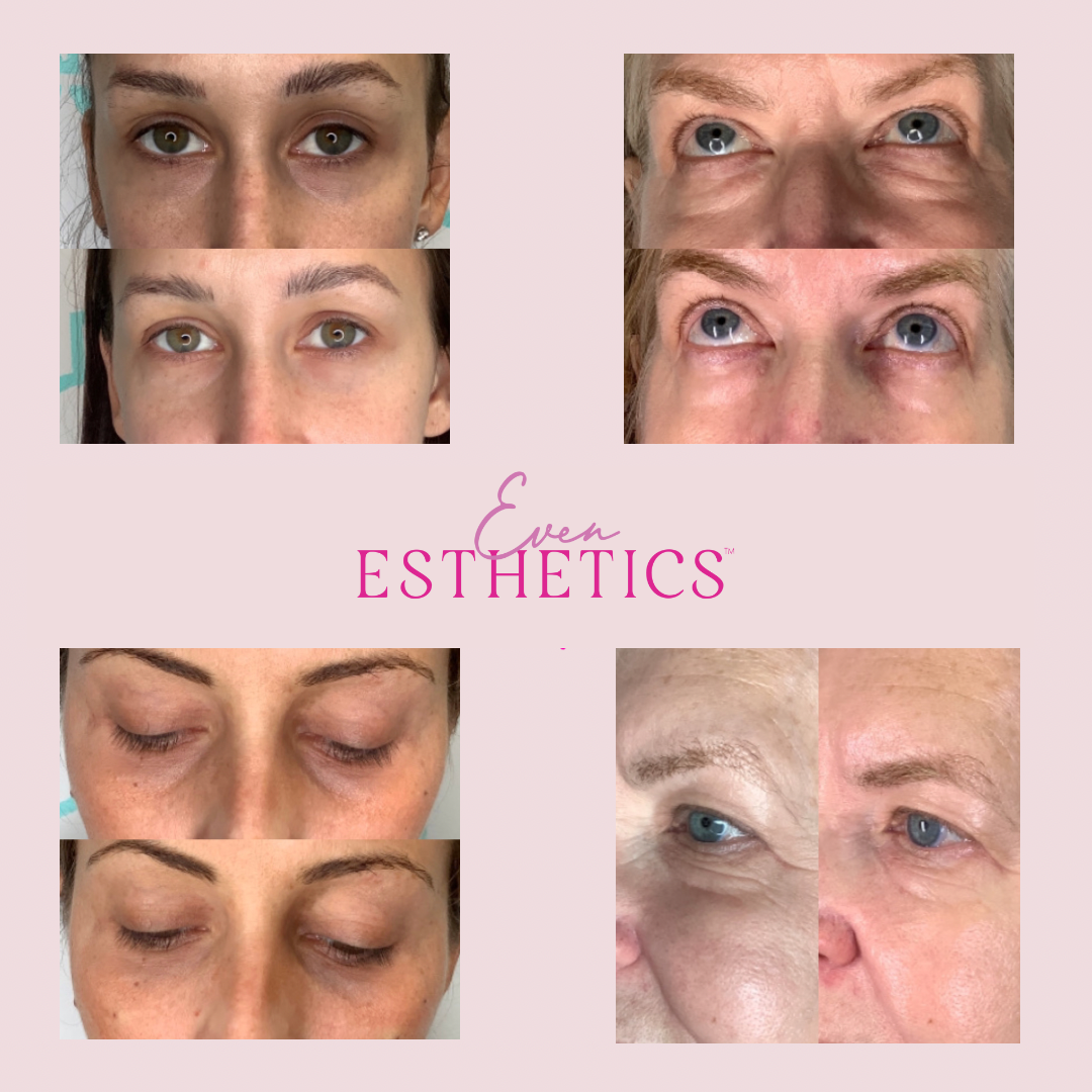 Under Eye Bags: A Plastic Surgeon Weighs In | IT Cosmetics