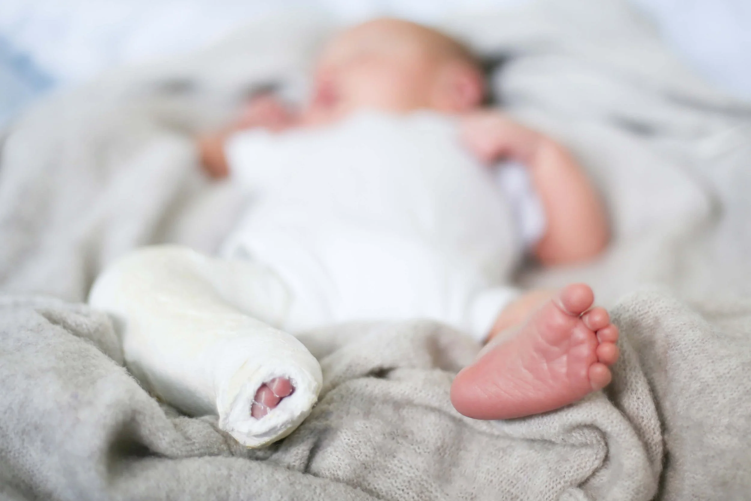 What Should You Do If Your Baby Has Clubfoot What Should You Do If Your Baby Has Clubfoot