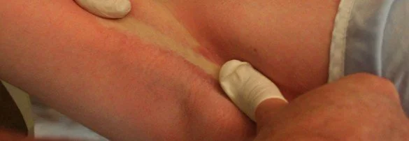 Dermal Fascial Restoration technique applying bidirectional tension to skin to create shearing forces in fascia