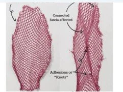Fascial adhesion showing how connective tissue becomes restricted and pulls on surrounding structures causing pain