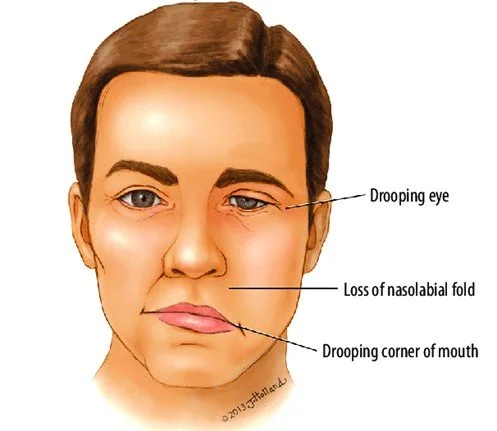 Facial Nerve Palsy - How physiotherapy can help
