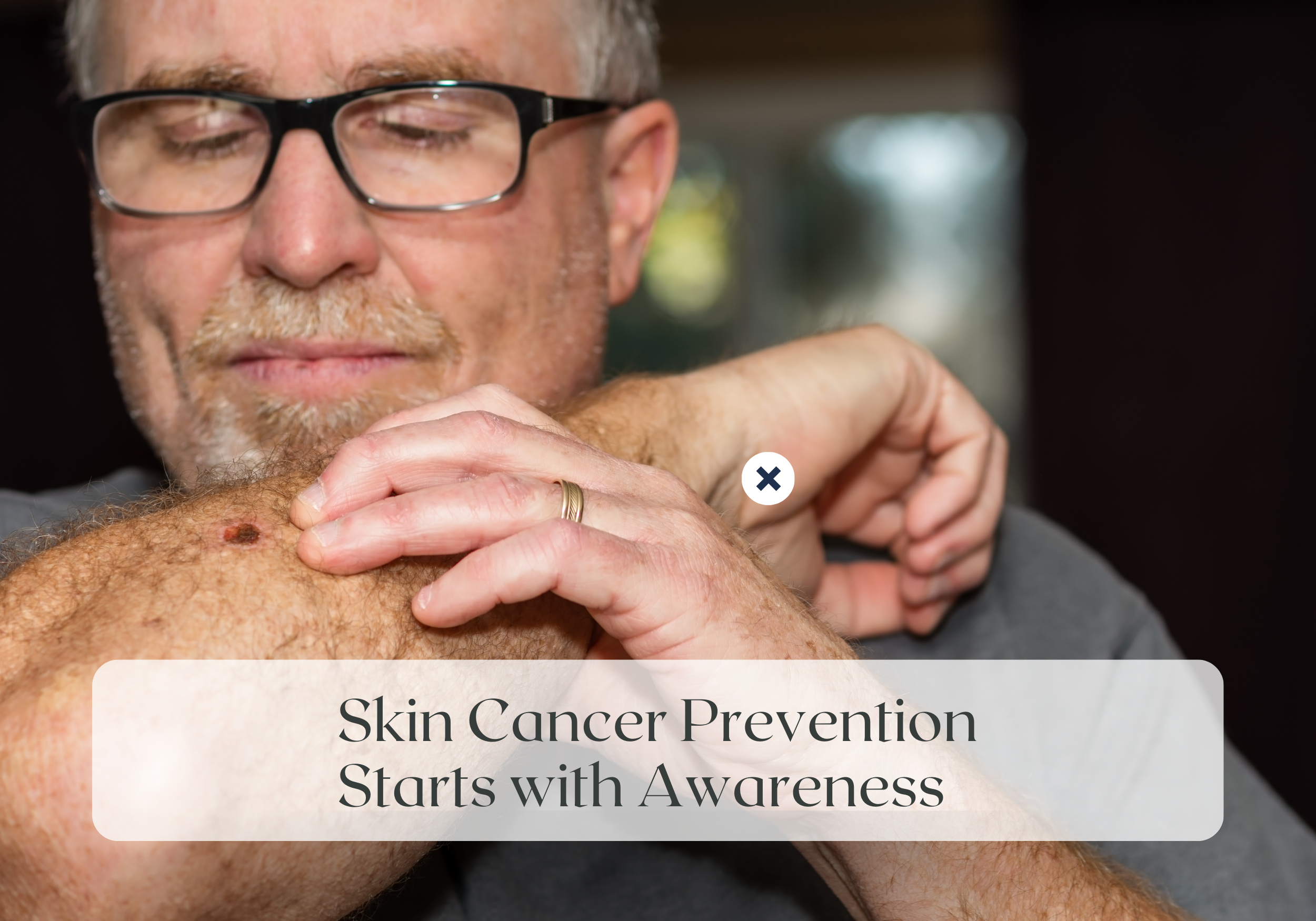 Wellness Wednesday: Skin Cancer Prevention Starts with Awareness
