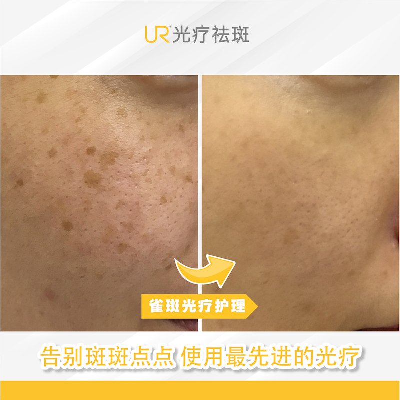 UR Freckles Before _ After 25-8-2020-02.jpg