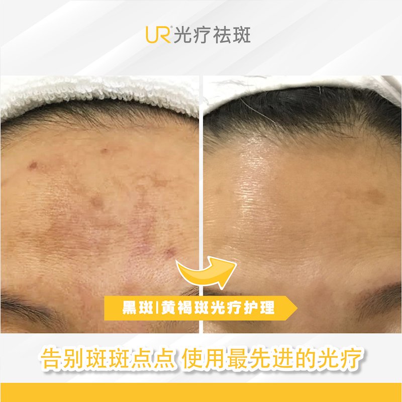 UR  Melasma Before _ After 25-8-2020-02.jpg