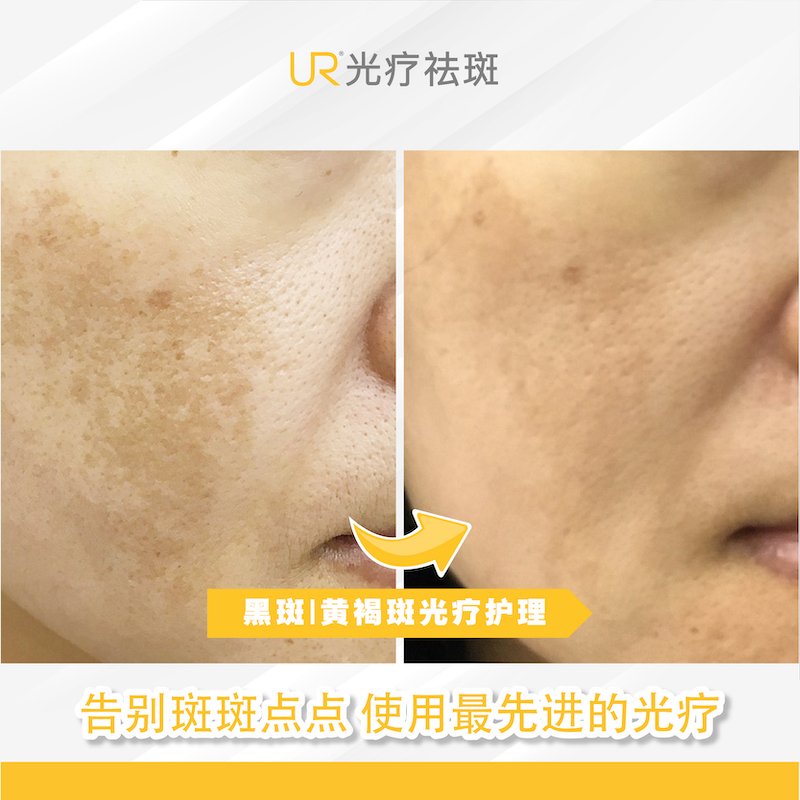 UR  Melasma Before _ After 25-8-2020-01.jpg