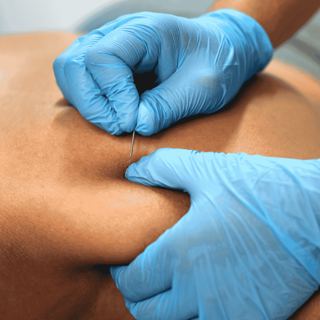 PT or Chiro dry needling the patients trap