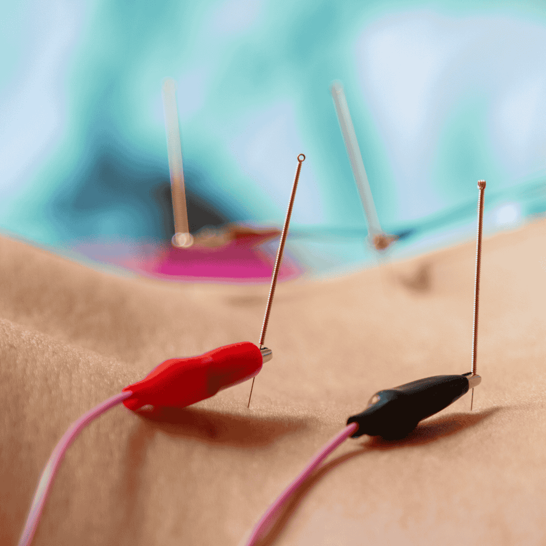 Close up of a few acu points hooked up to e-stim