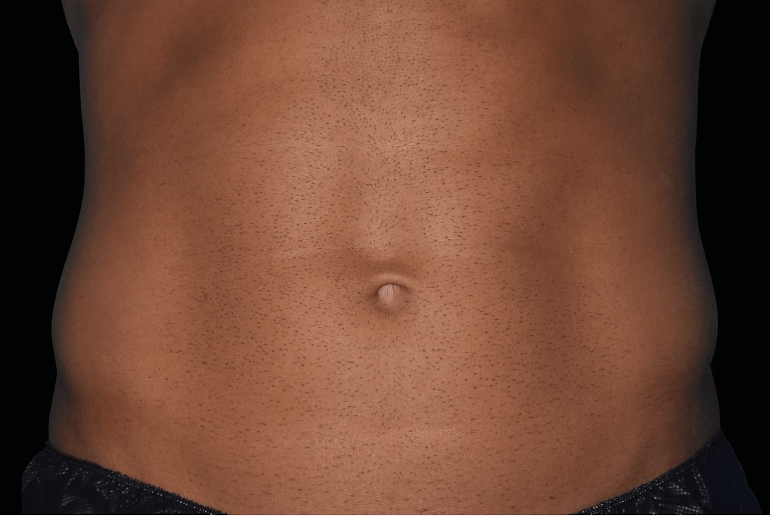 Emsculpt Neo after male abdomen 2 - WestEnd MedSpa