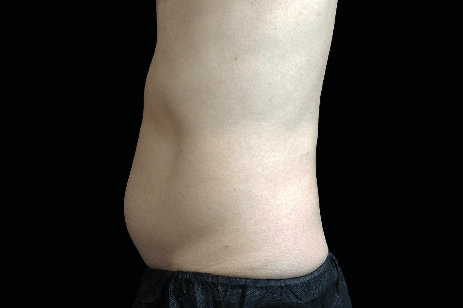 Emsculpt Neo after male abdomen 3 - WestEnd MedSpa