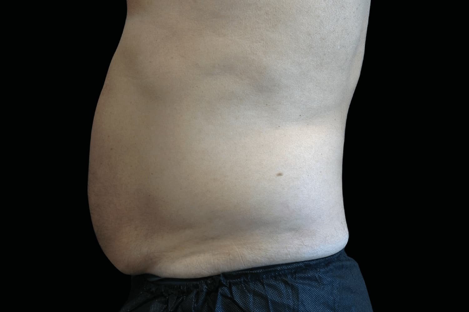 Emsculpt Neo after male abdomen 1 - WestEnd MedSpa