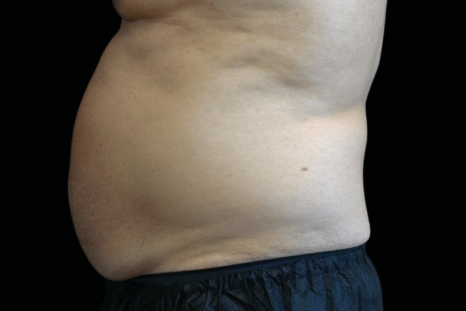 Emsculpt Neo before male abdomen 2 - WestEnd MedSpa