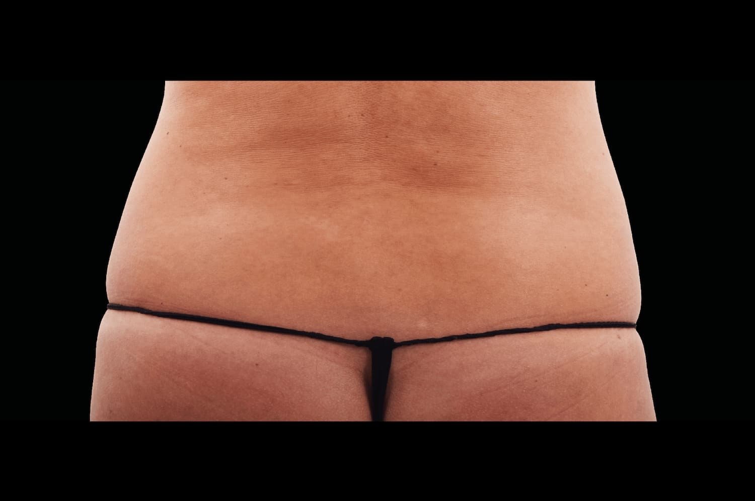 Emsculpt Neo after female lateral abdomen 1 - WestEnd MedSpa