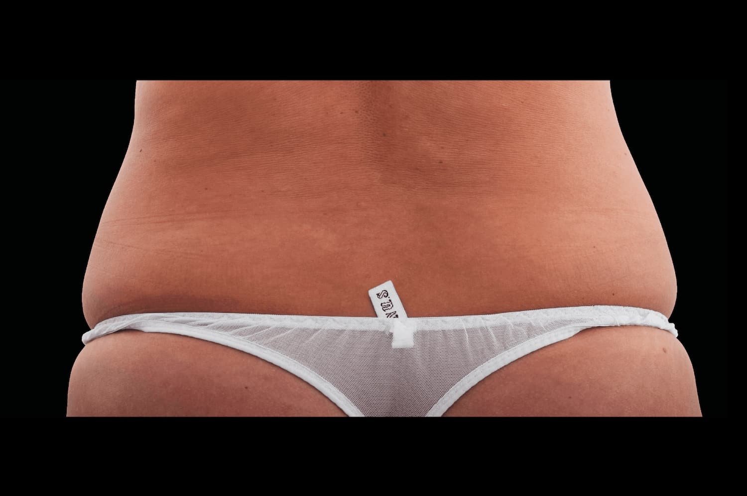 Emsculpt Neo before female lateral abdomen 1 - WestEnd MedSpa