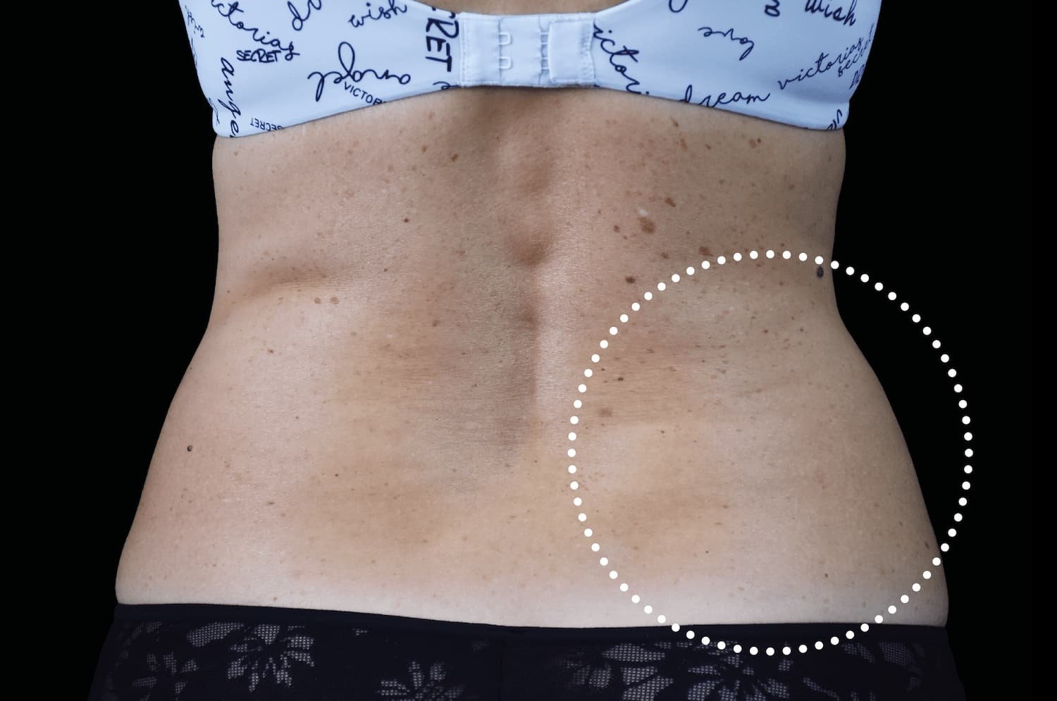 Emsculpt Neo before female lateral abdomen 2 - WestEnd MedSpa