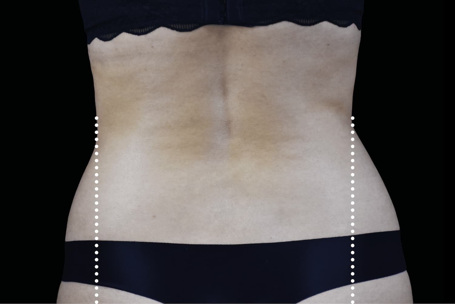 Emsculpt_Neo_PIC_Ba-card-female-lateral-abdomen-101_ENUS100  AFTER.jpeg