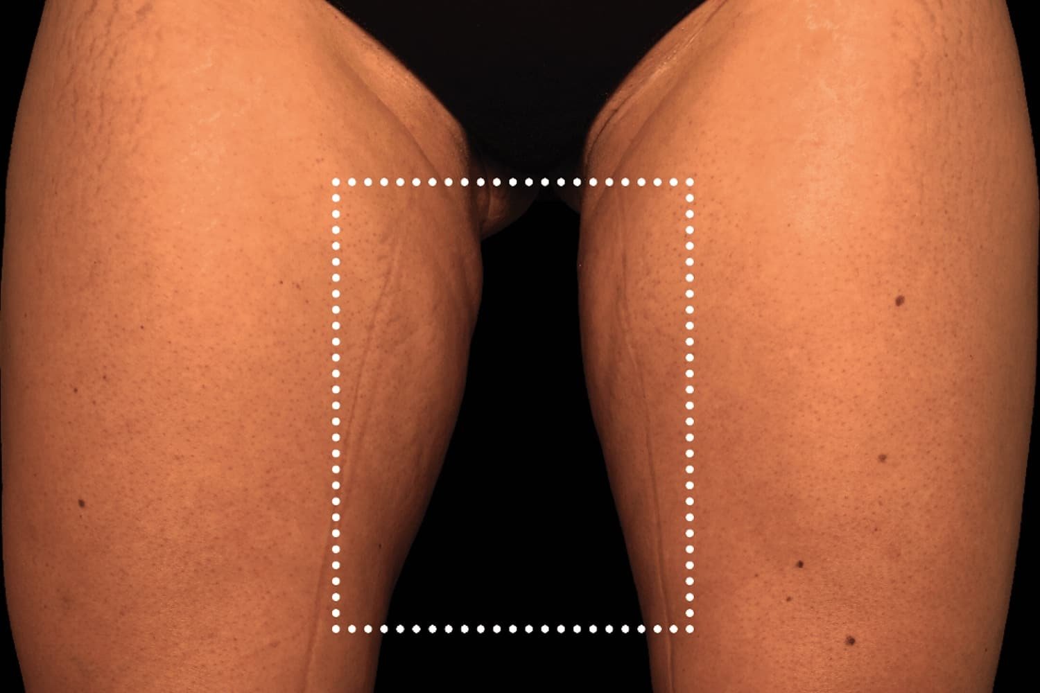 Emsculpt Neo after female inner thighs - WestEnd MedSpa