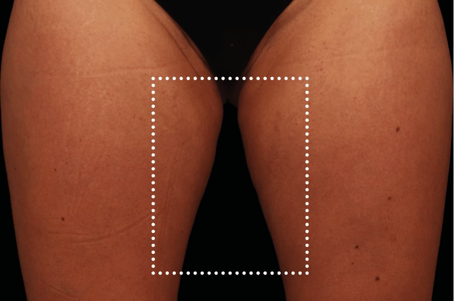 Emsculpt Neo before female inner thighs - WestEnd MedSpa