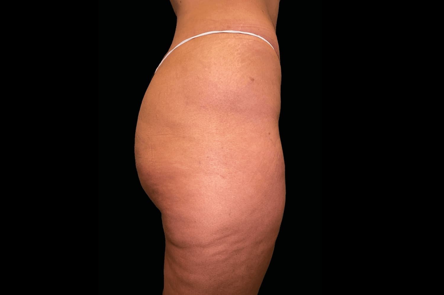 Emsculpt Neo after female buttock - WestEnd MedSpa