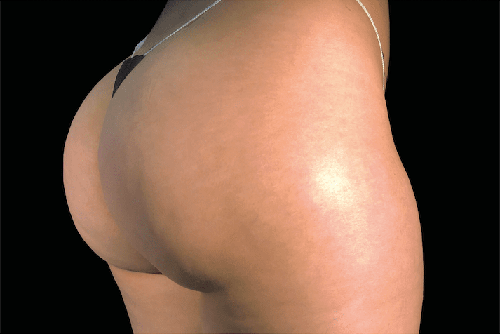 Emtone Cellulite Reduction - After 1 - WestEnd MedSpa