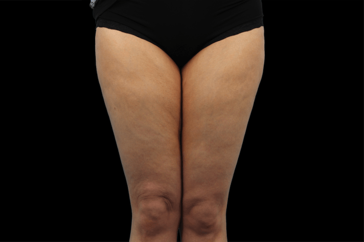 Emtone Cellulite Reduction - Before 2 - WestEnd MedSpa