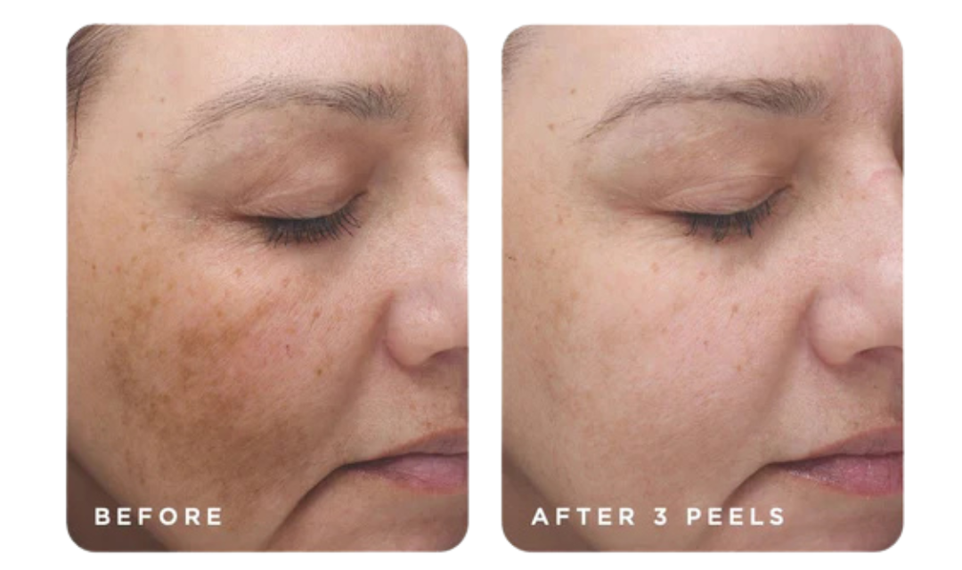 The VI Peel: A Powerful, Results-Driven Chemical Peel at WestEnd MedSpa