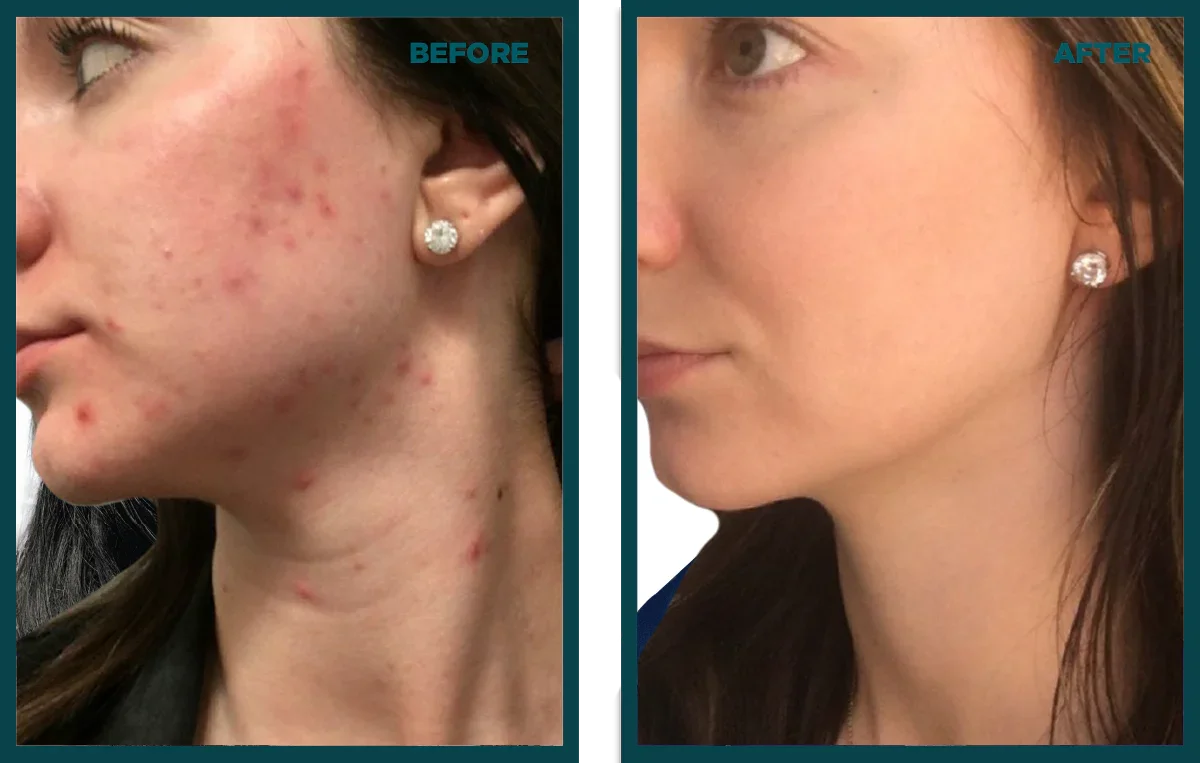 Reset. Repair. Reveal: The VI Peel + Microneedling Series