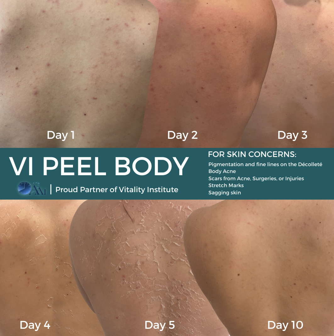 Introducing VI Peel Body at WestEnd MedSpa