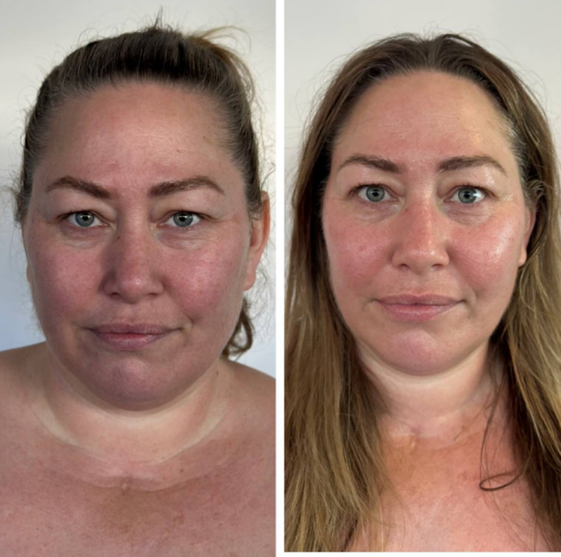 Graduation Glow in Aspen: The Best Pre-Event Facial Treatment for Lifted, Radiant Skin