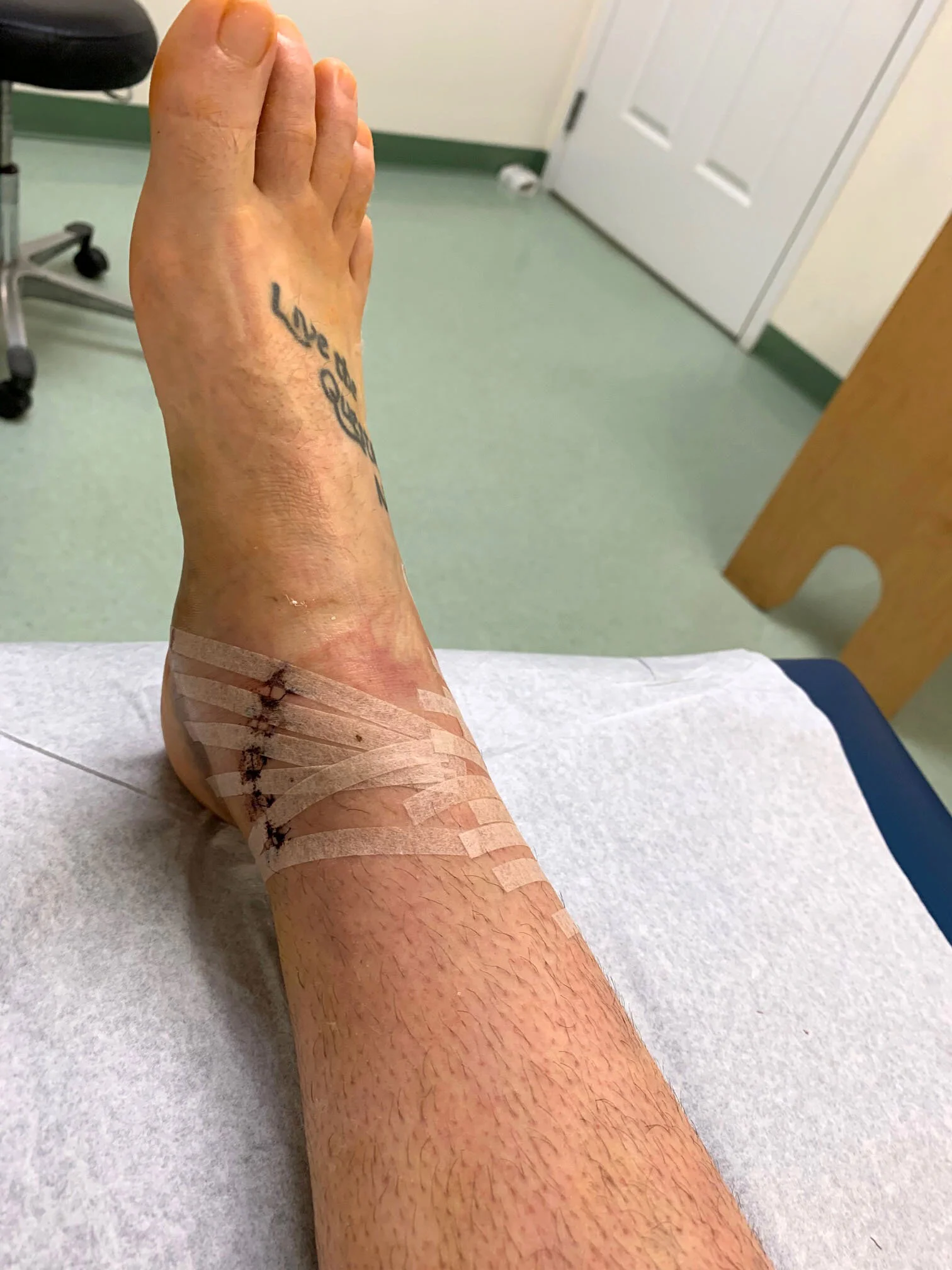 Ankle Fracture - the cast comes off.jpg