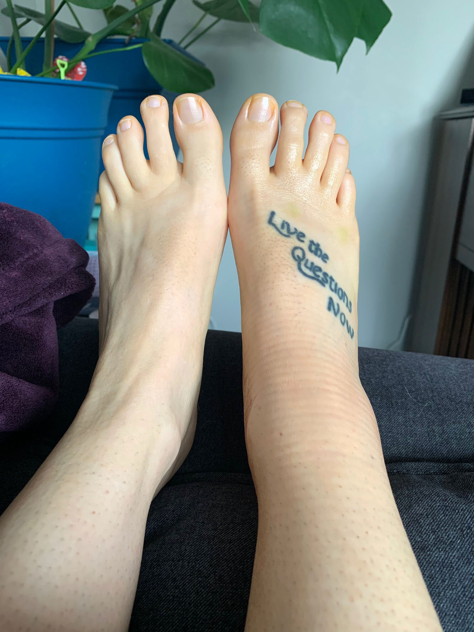Ankle Fracture - leg comparison one month after surgery.jpg