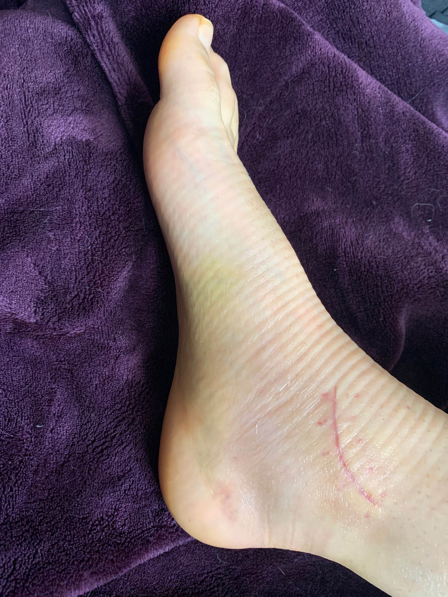 Ankle Fracture - one month after surgery inner ankle.jpg