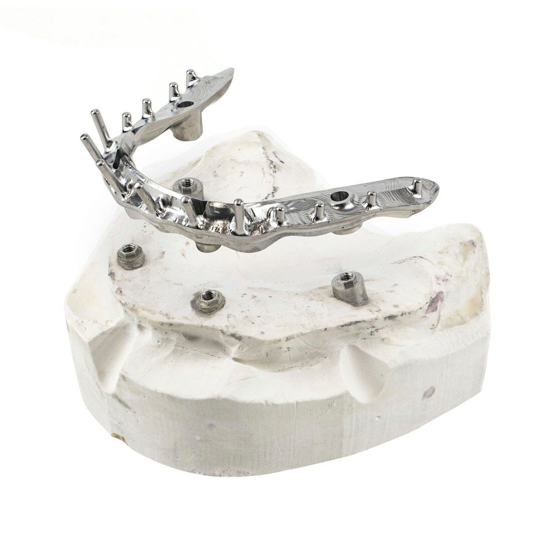 November's Case of the Month

The client requested a fixed framework to be designed for the maxillary arch on 4 implants.

Based on the requirements, a fixed Melbourne Bar was chosen, the characteristics of the Melbourne Bar allow for a profile that 