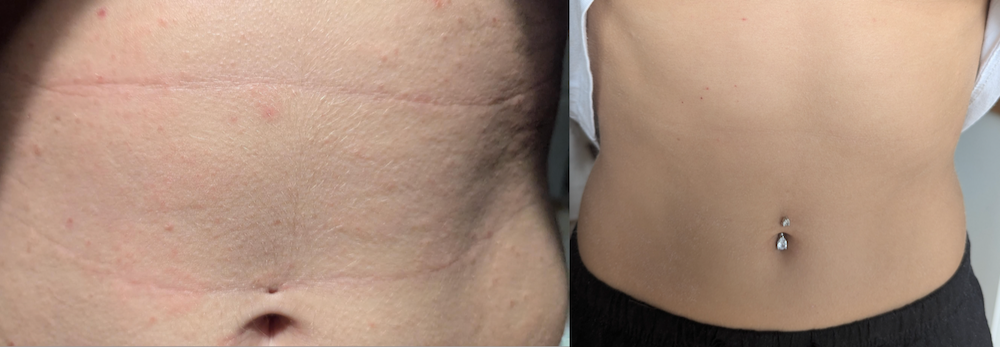 Stomach before and after treatment