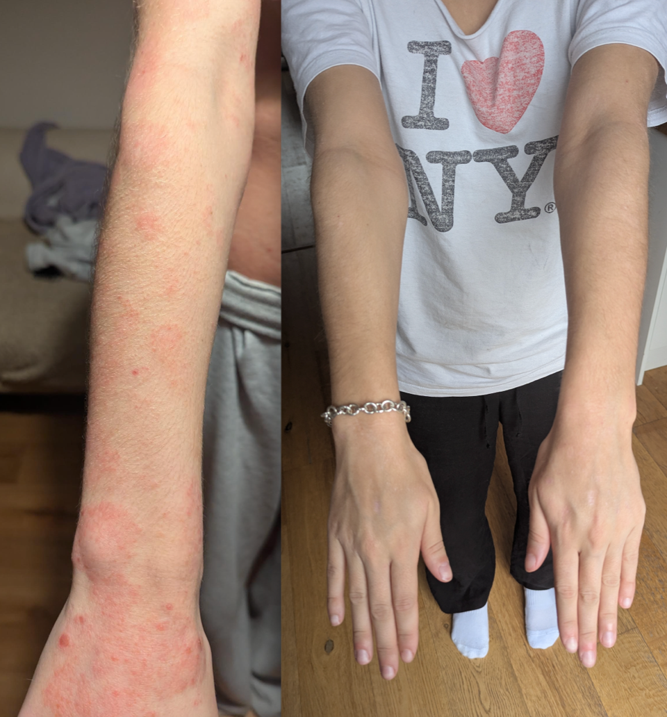 Arms and backs of hands before and after treatment