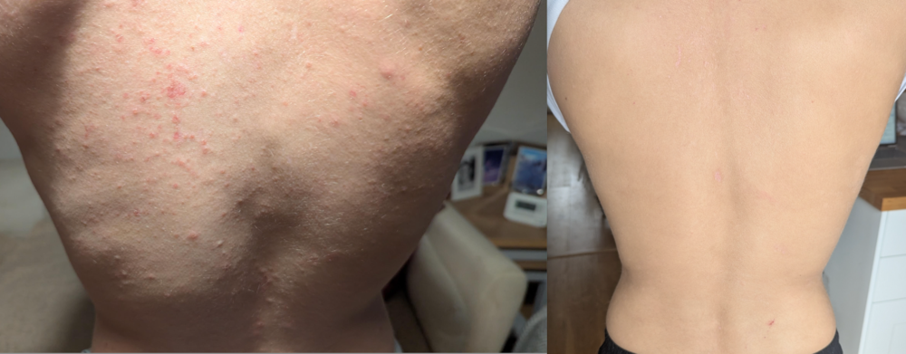 Back before and after treatment