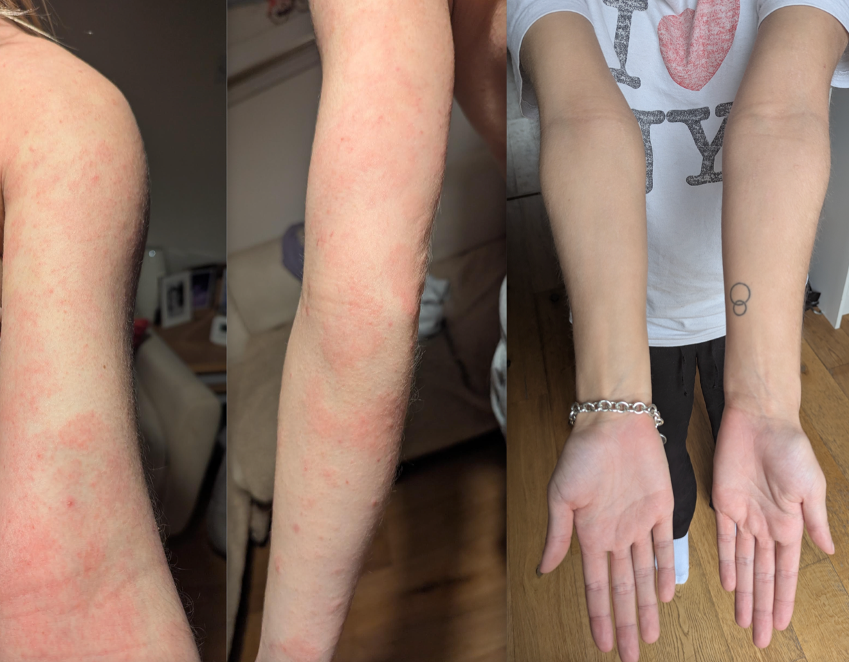 Arms before and after treatment