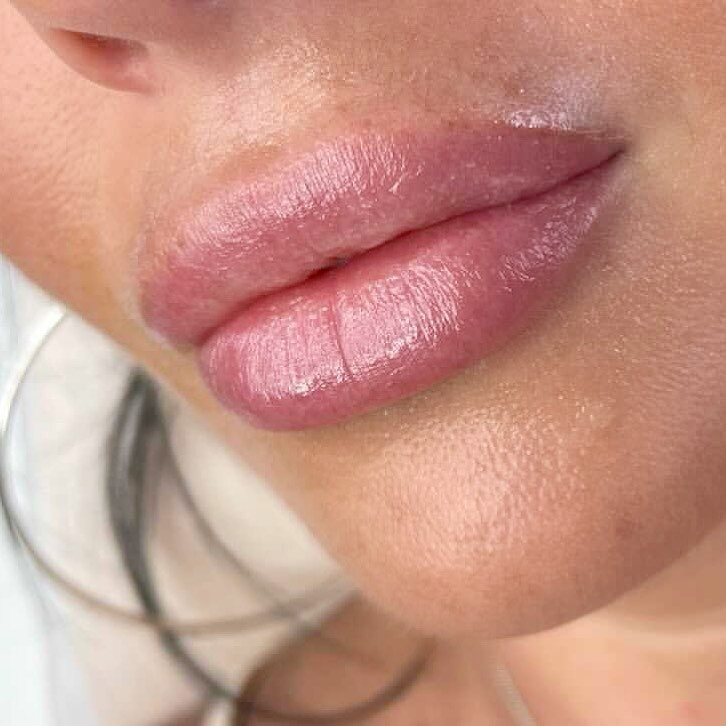 The natural pout 👄💉
We are now booking appointments for August 6 for our next popup with @danielabeautynurse from 11-7! Please send her a DM for all bookings and questions.