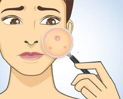WHAT IS CAUSING YOUR ACNE? — IN SYMMETRY