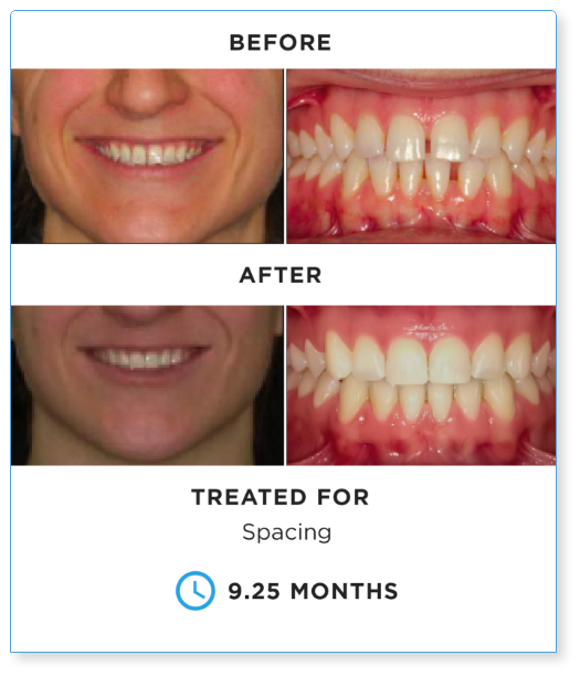 SureSmile_BEFORE-AND-AFTER-1 (1).png