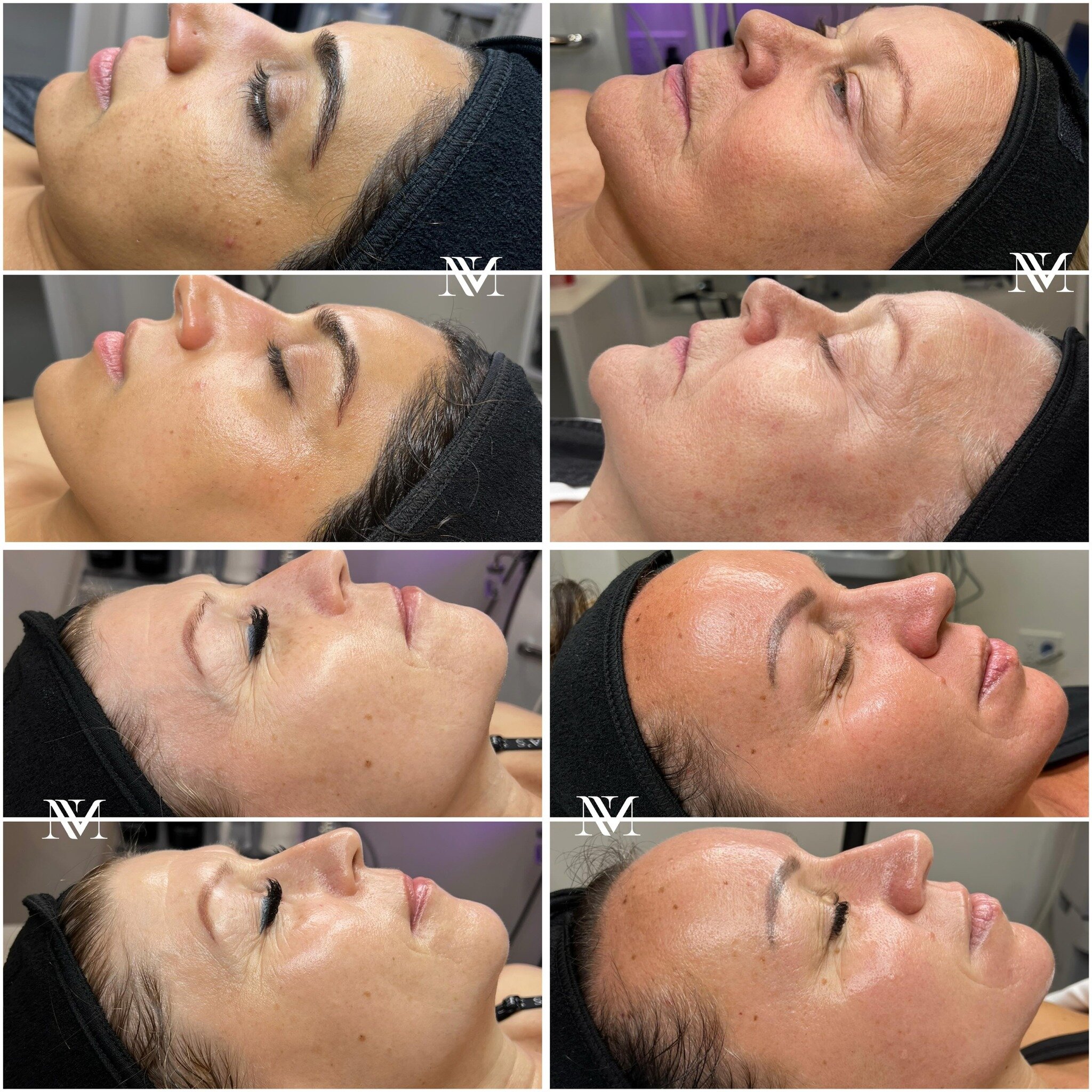 ✨Creating Beautiful Face With Lasting Results!✨

Our commitment is to always give our clients the finest standard of professional care in a private, welcoming environment. Rather than simply offering a service, we go above and beyond to make sure eac