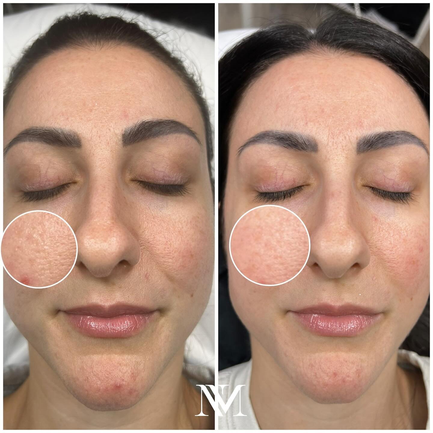 I don&rsquo;t promise miracles&hellip;Instead I deliver results! #yourmedicalaesthetician 

Look at these amazing progress photos achieved with using ONLY skincare in the comfort of her own home! #zoskinhealth 

✨Power of MEDICAL GRADE SKINCARE✨ 
My 