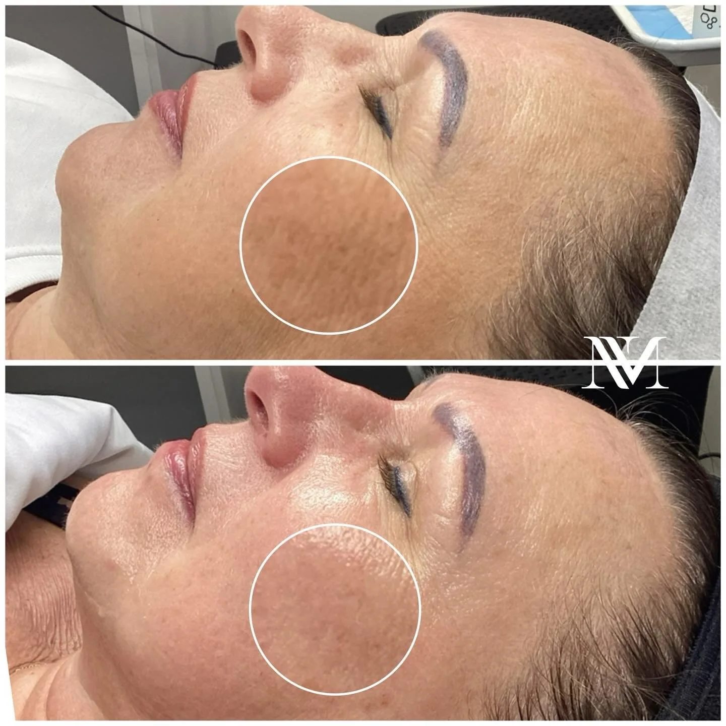 ✨She didn&rsquo;t want injectables BUT she wanted results✨

After just 2 treatments no injectables, no needles look at my clients incredible transformation.

✔️ Smoother texture
✔️ Deep hydration
✔️ Brighter, more radiant glow
✔️ Softened fine lines
