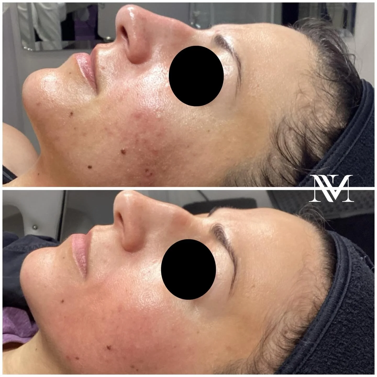 ✨Multiple skin concerns? The order you treat them in is everything ✨

When I take on a client with more than one skin concern ( complex skin) I make sure to create a proper treatment plan to deliver the transformative results they need.

And I did ju