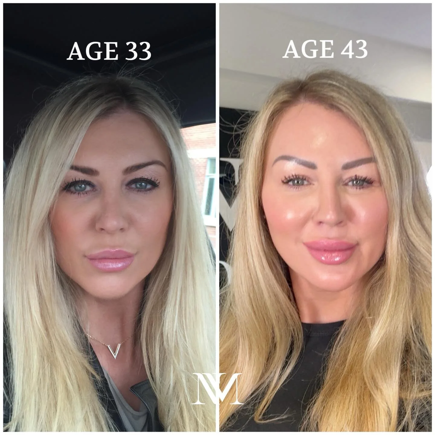 ✨This is 10 years of intention &mdash; not intervention.✨

AGE 33 &rarr; AGE 43

Same face.
Different approach.

Looking back at my journey, my face is the same, but my philosophy is entirely different.

As a medical aesthetician and founder, I&rsquo