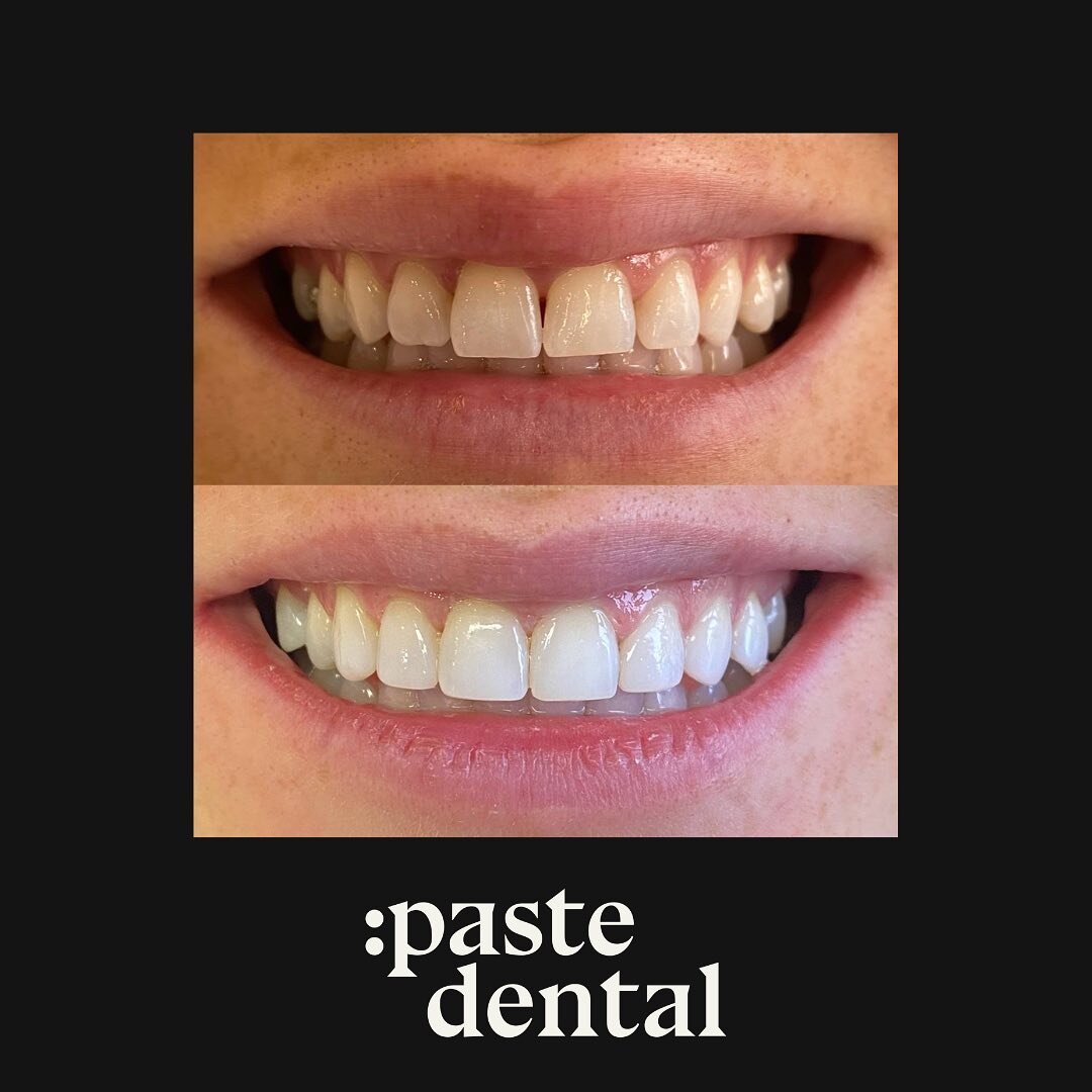 @drlaurenlaverty is a pro when it comes to subtle smile makeovers. 

That &ldquo;why does they look so good&rdquo; vibe that is hard to place but yet, fresh, healthy and calm. 

Now booking smile makeovers @pastedental 

Composite bonding 
Recontouri