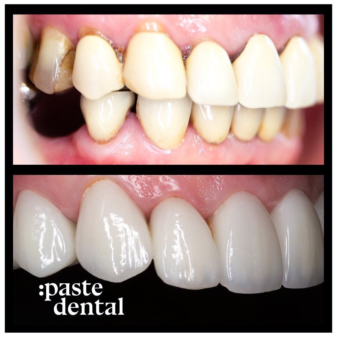 What a transformation! 

Dentistry has a lifetime and as we treatment plan we also plan for our work failing and need replaced! 

We hope that is many years into the future but we are always honest about the prognosis of intervention and expectations