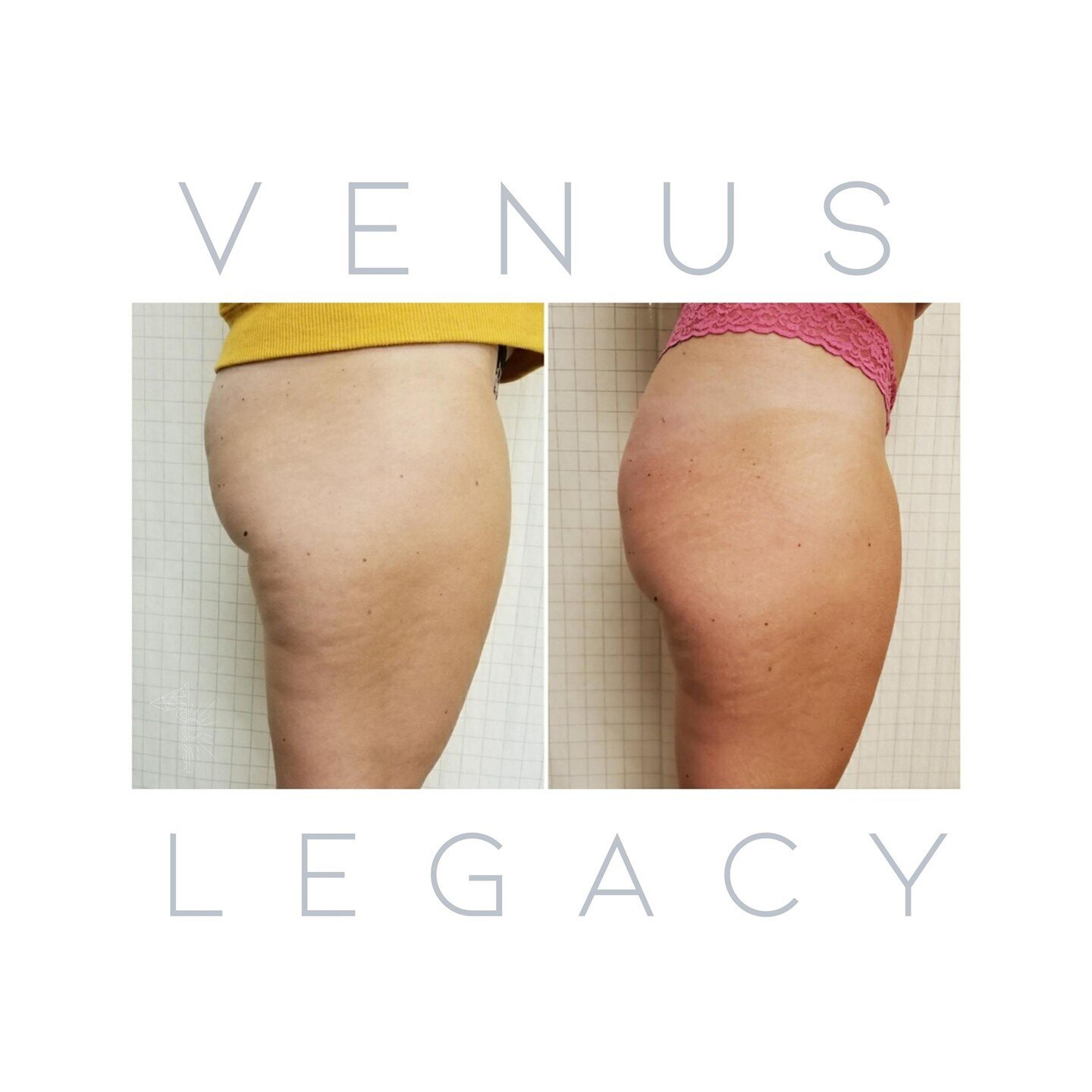 Our Venus Legacy treatment uses heat to naturally boost collagen production and shrink fat cells, which tightens sagging skin, smooths out cellulite and wrinkles, and makes your body and face look more sculpted! What's not to love?⁠
⁠