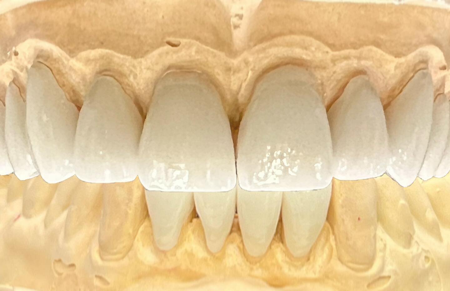 I see 14 beautiful reasons to smile!!
Thanks @inspiredentalgroup. We can&rsquo;t wait to see this on your patient!

#bcdental #smiledesign #dentist #veneers #emaxpress #dentalrestoration #dentallab #bcdentallab #globalceramicslab