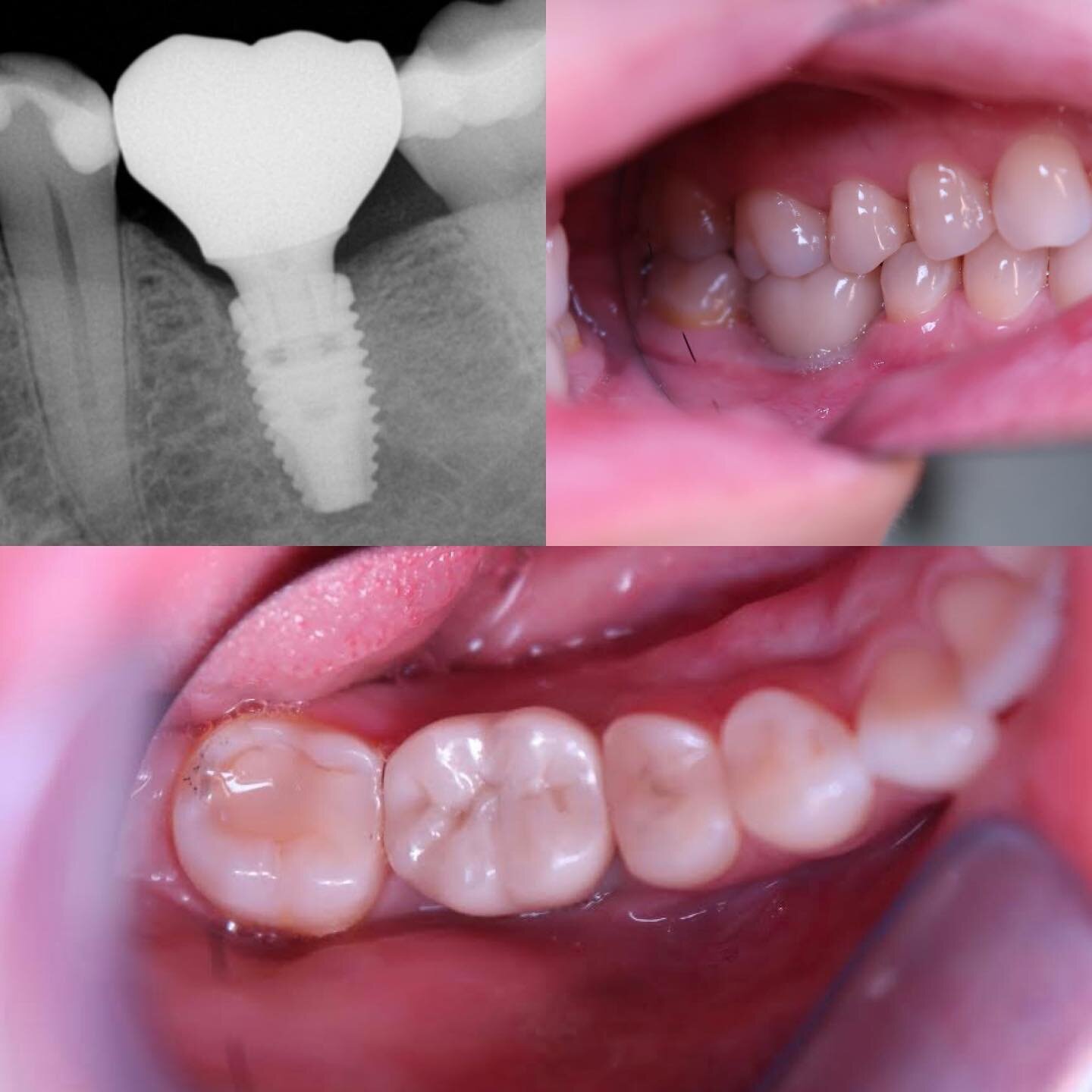 Another perfect fitting digital implant crown. We are more than just a crown &amp; bridge lab!

#bcdental #smiledesign #dentist #veneers #dentalimplants #dentalrestoration #dentallab #globalceramicslab